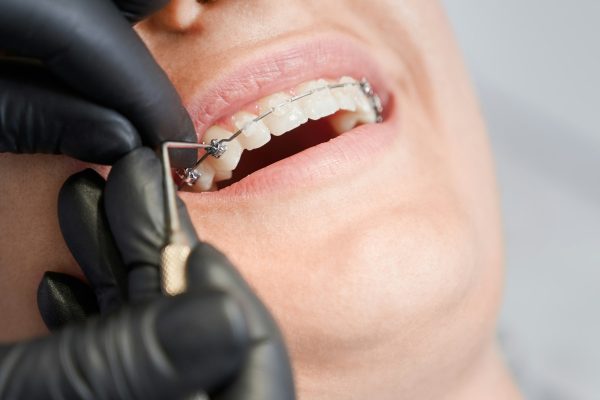 Cropped macro snapshot of teeth with ceramic and metal brackets at dentist office